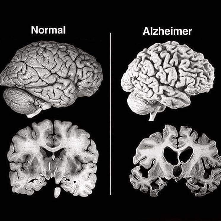 Two brain scans side by side: a normal brain and a brain with Alzheimer's